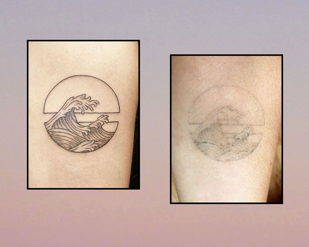 短暂的纹身愈合过程在0和9个月